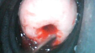 want an extreme close-up? ???? endoscope view of sounding my menstruating cervix